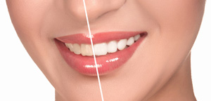 Porcelain veneers on teeth
